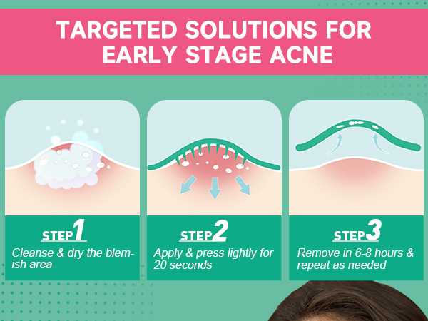 TARGETED SOLUTIONS FOR EARLY STAGE ACNE