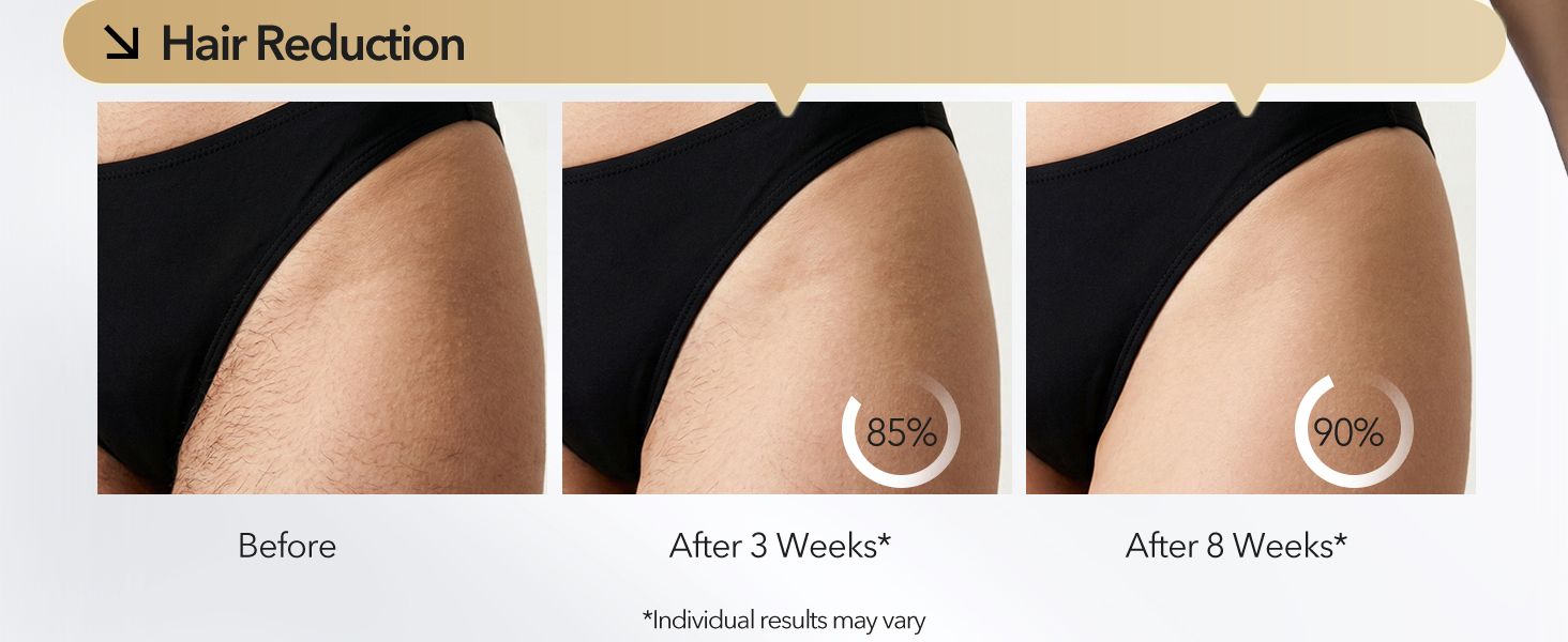 laser hair removal