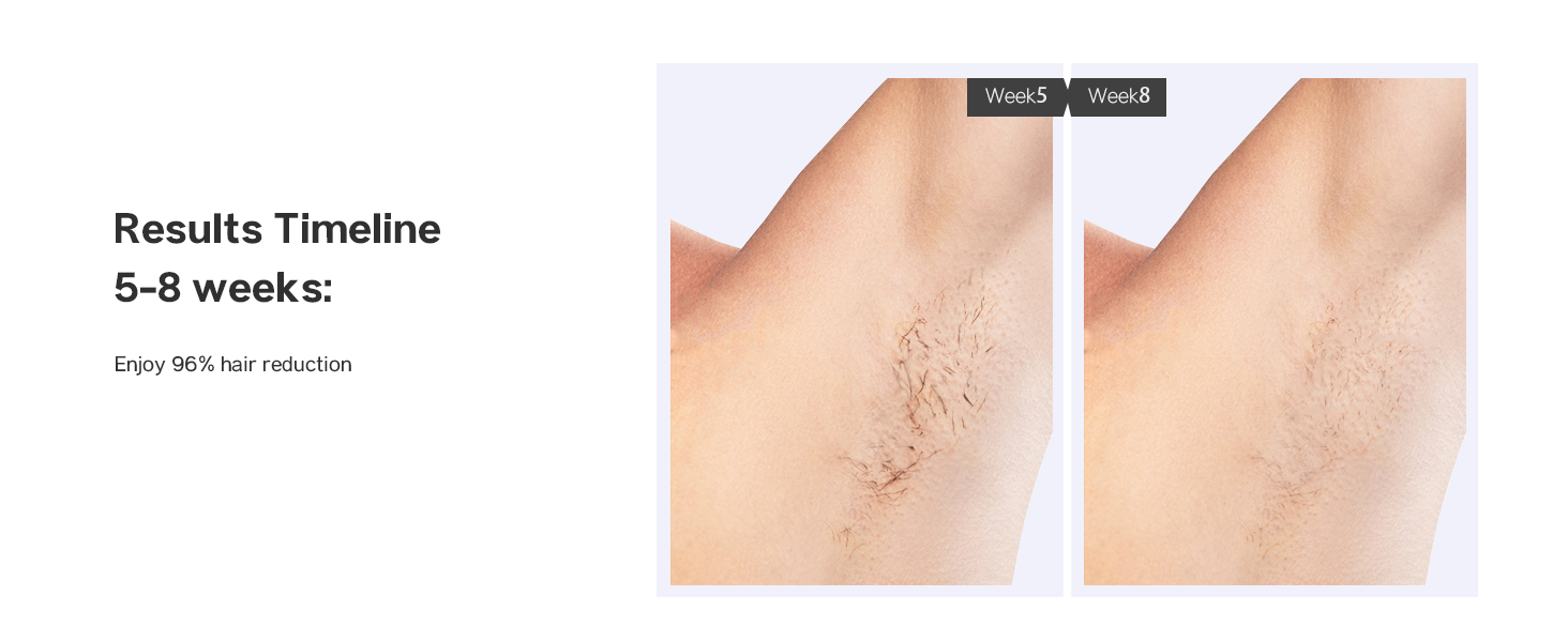 laser hair removal device