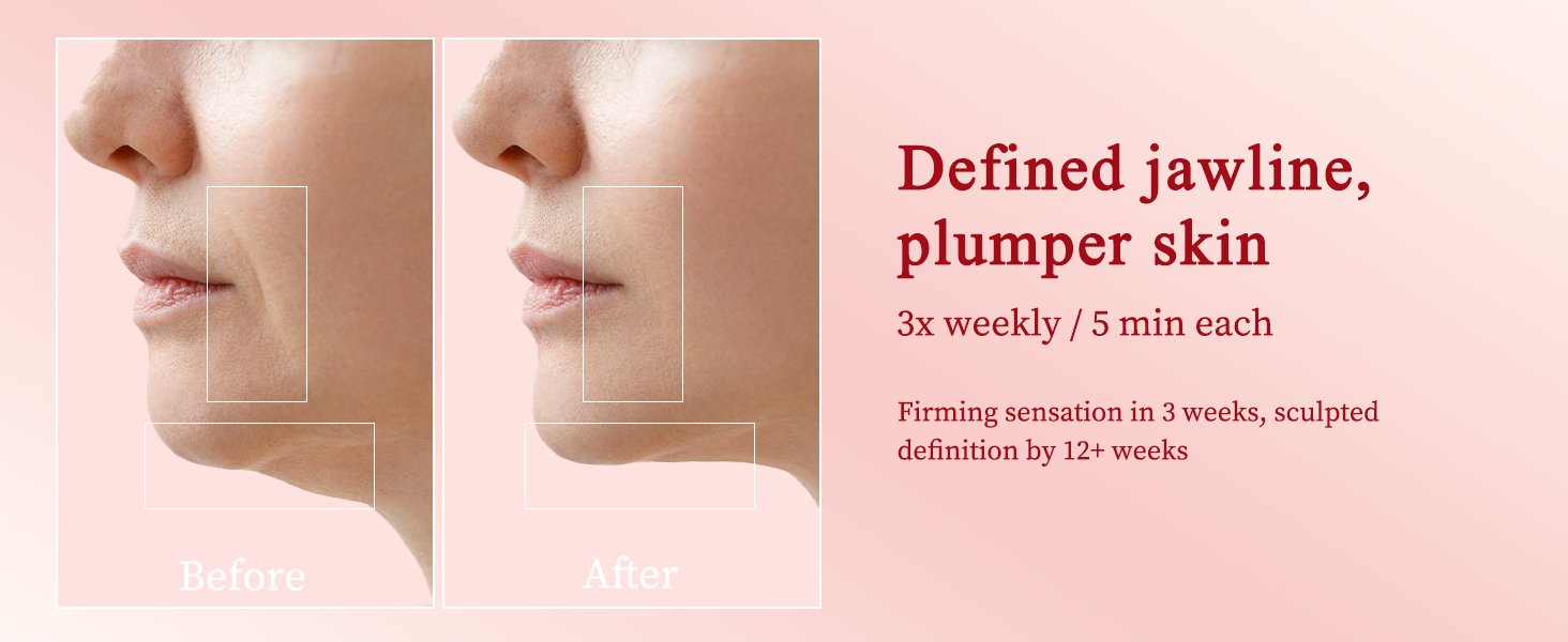 RadioFrequency Skin Tightening Device