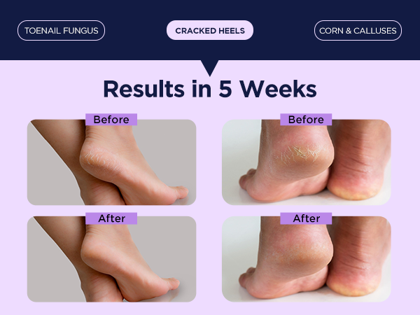 Cracked Heel