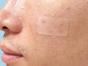 Hydrocolloid Patches