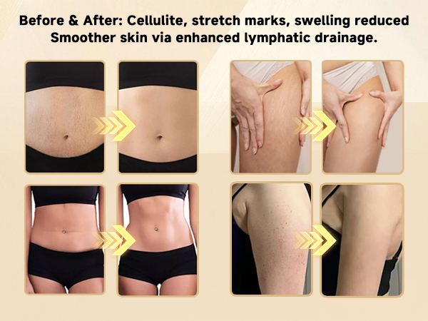 cellulite massage tool