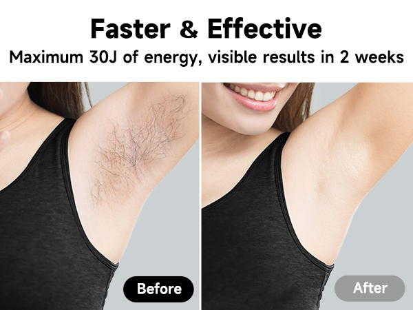 facial hair removal for women