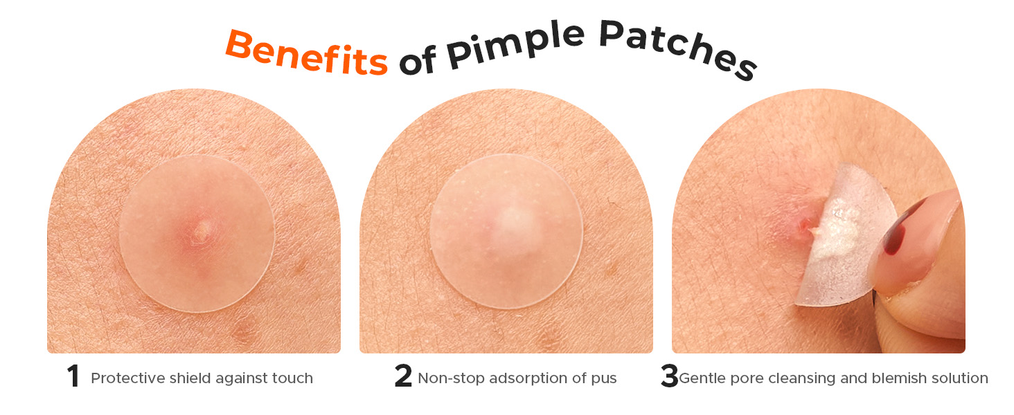 Benefits of Pimple Patches
