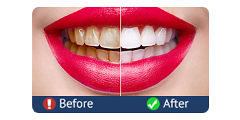 whiten tooth-1