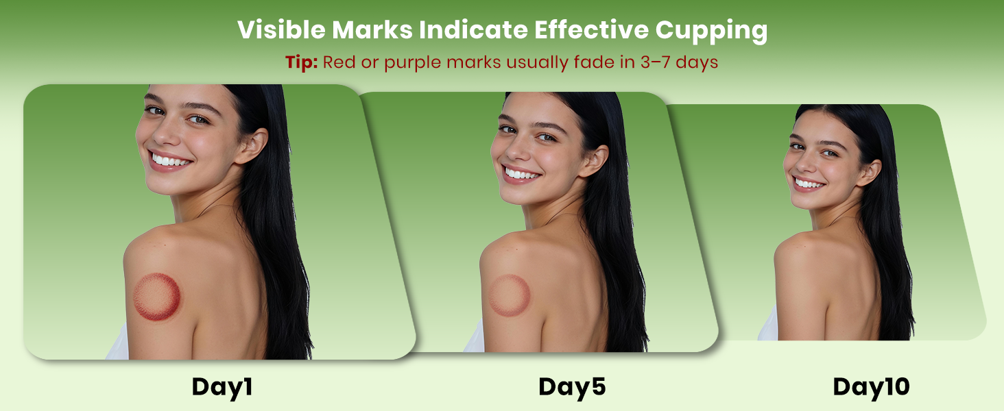 cupping set
