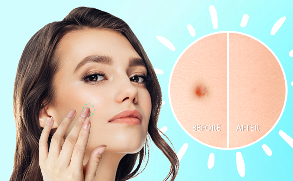 Pimple Patches for Face