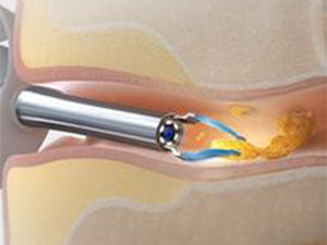 Multiple cleaning methods