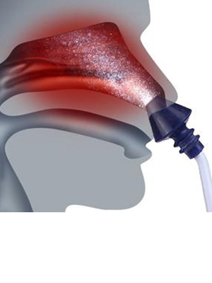 illustration of sinu pulse use as the spray clears the sinus cavities and provides sinus relief