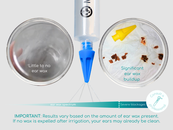 ear syringe with basins on both side showing no earwax and ear wax on the other basin
