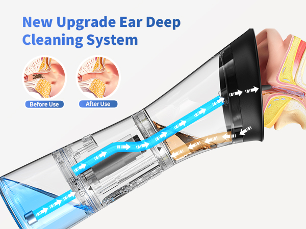 earwax removal