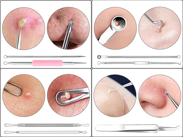 Acne Pimple Extractor Tool