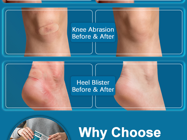 ADVANCED HYDROCOLLOID TECHNOLOGY ACCELERATED HEALING FOR DIVERSE WOUNDS (3)