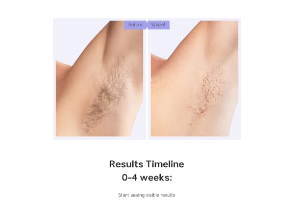 laser hair removal device