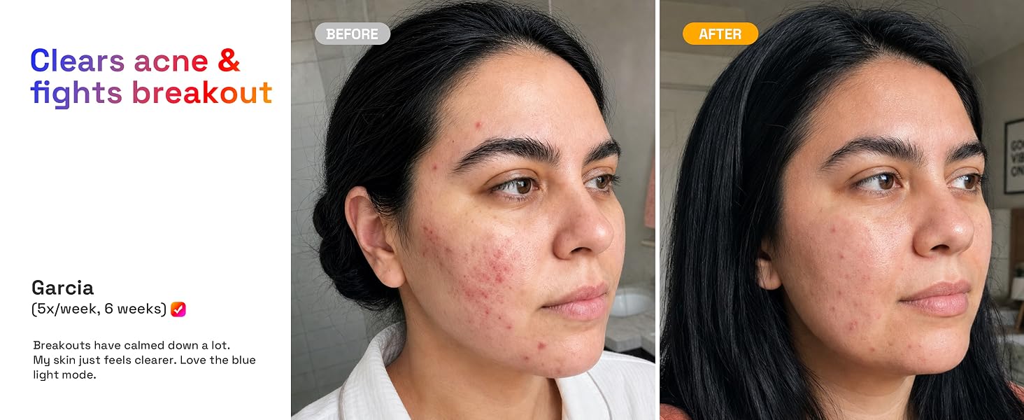 Clears acne