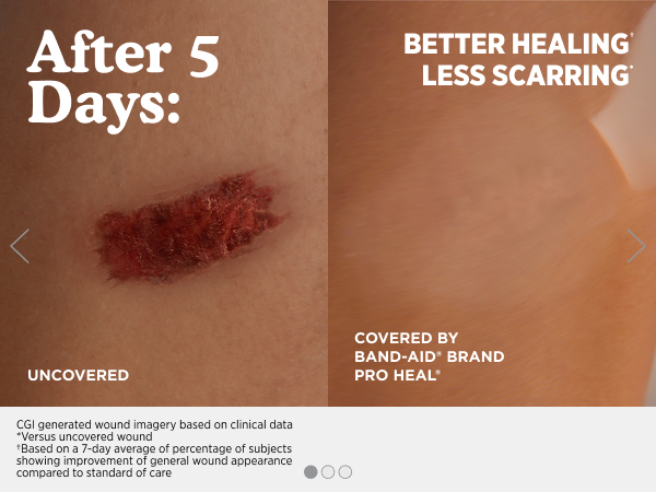 Better Healing and Less Scarring Compared to Uncovered Wound