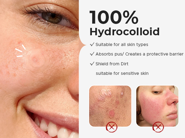 Text reads '100% Hydrocolloid' with checkmarks: 'Suitable for all skin types', 'Absorbs pus', 'Creates a protective barrier', 'Shield from dirt', 'suitable for sensitive skin'. Close-up images show hydrocolloid patches applied to skin with acne.