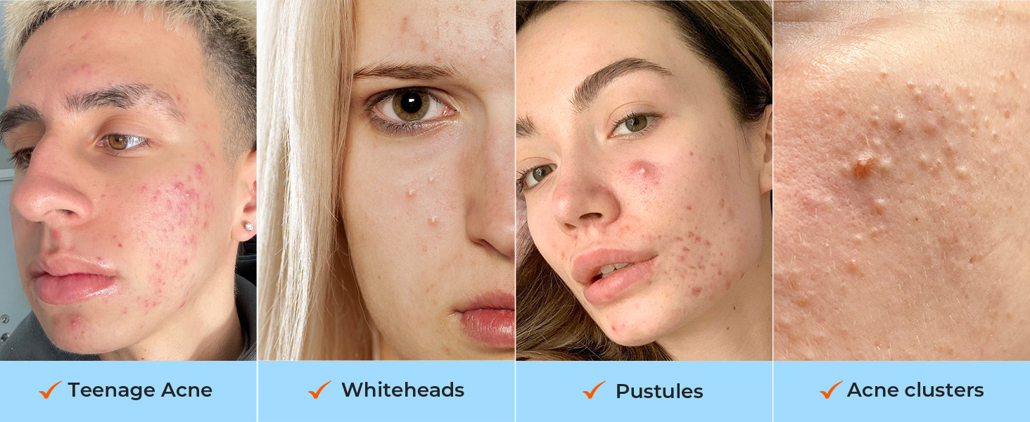 large pimple patches