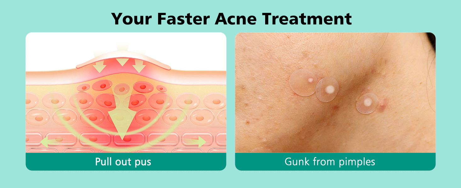 pimple patches
