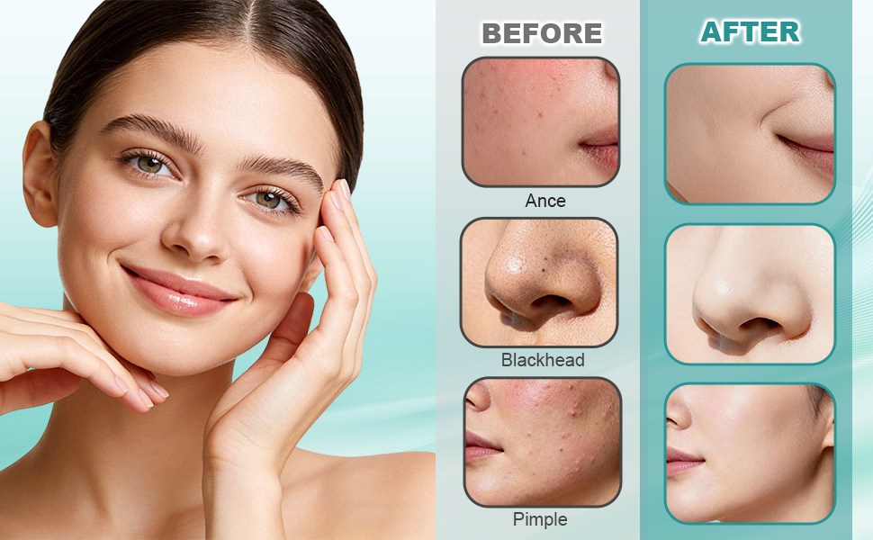 Precision needles help target acne concerns efficiently.