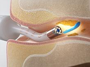 Multiple cleaning methods