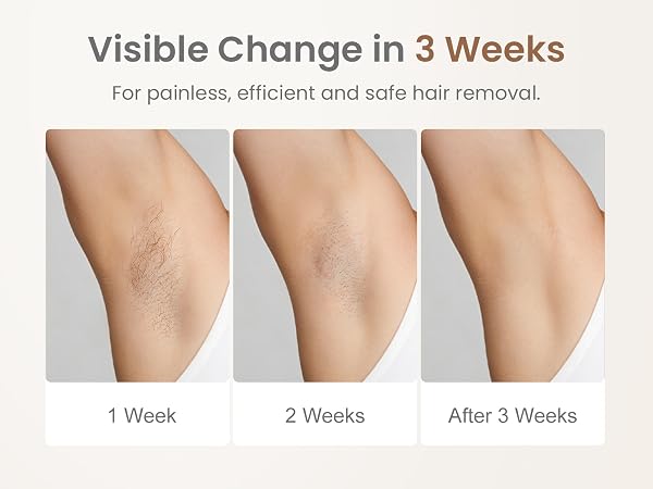 laser hair removal for women