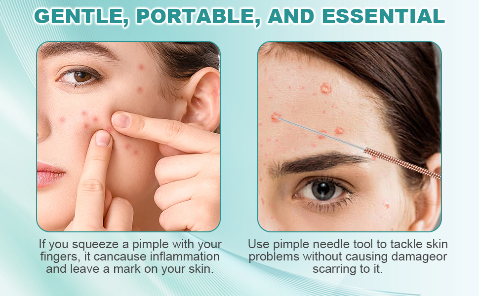Safely lance pimples and blackheads — release impurities without squeezing
