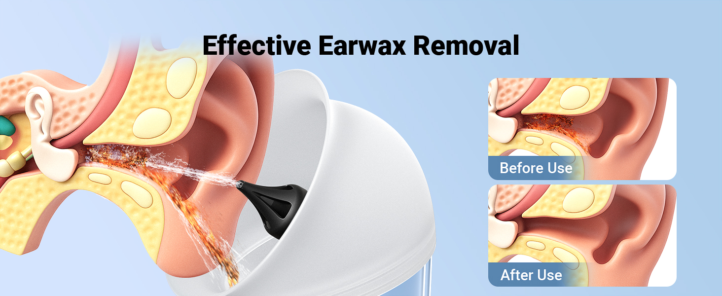 Earwax Removal, Ear Cleaner