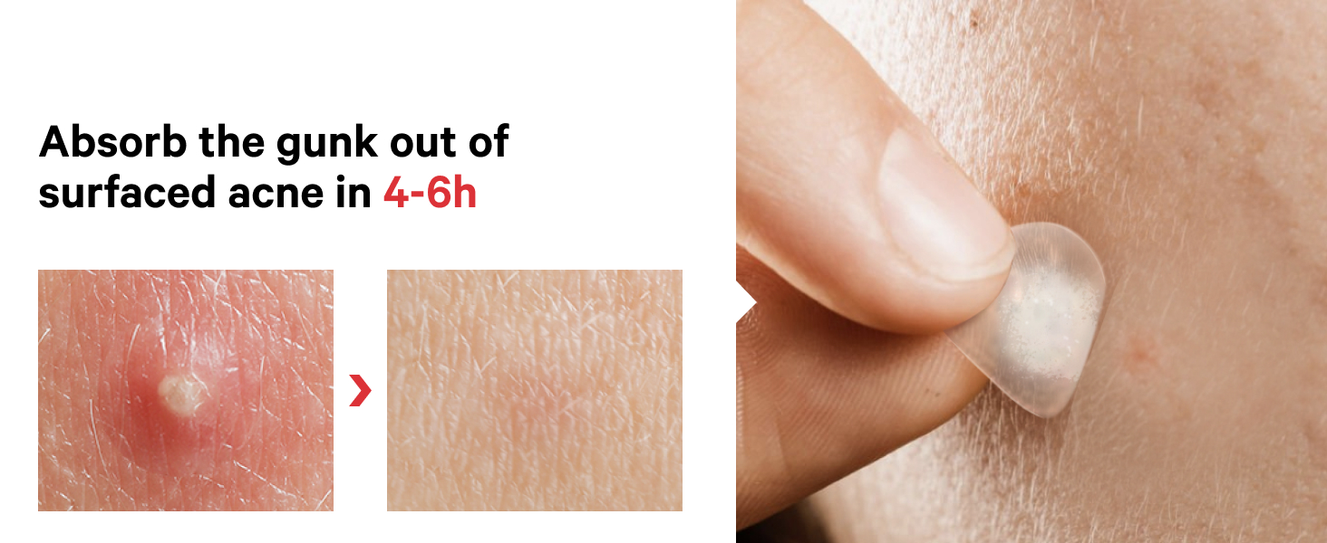 Acne spot treatment absorb the gunk in 4-6h pimple patches invisible blemish spot treatment