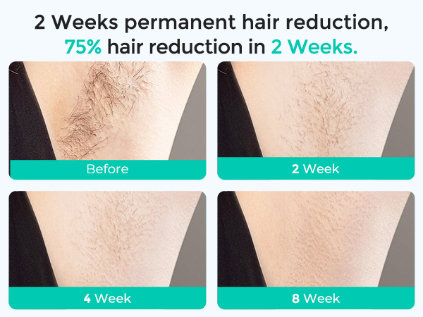 lubex ipl laser hair removal