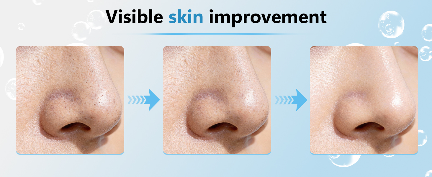 Blackhead Vacuum Remover