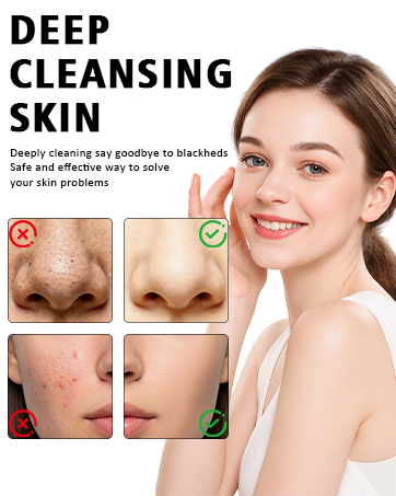 Blackhead Remover Pore Vacuum