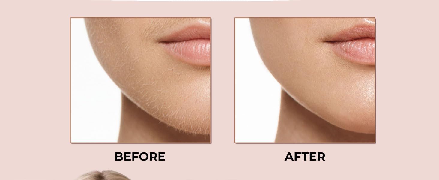 Facial Hair Removal for Women