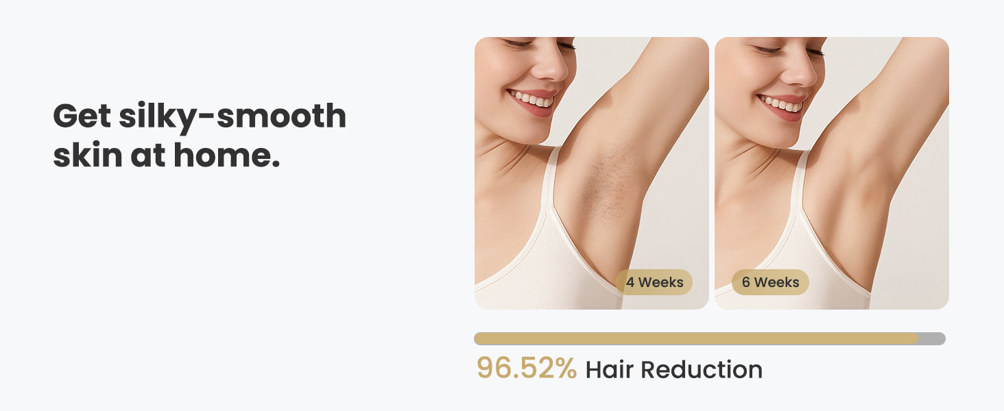 laser hair removal for women