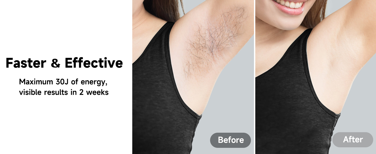 facial hair removal for women