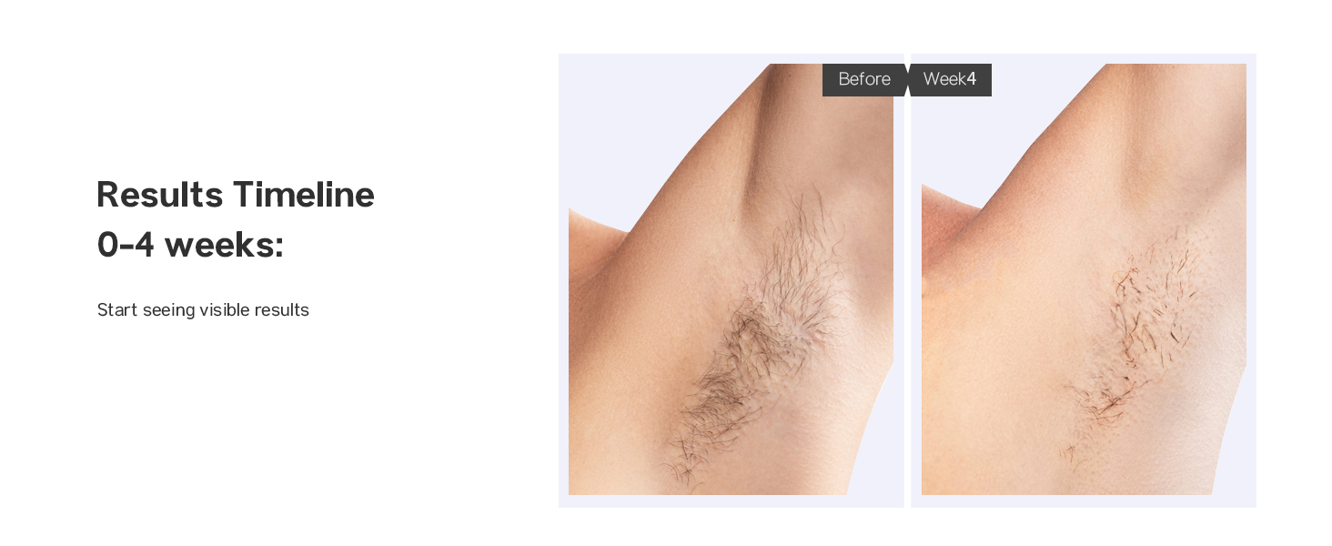 laser hair removal device