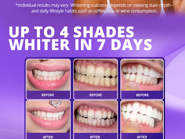 whitening-02