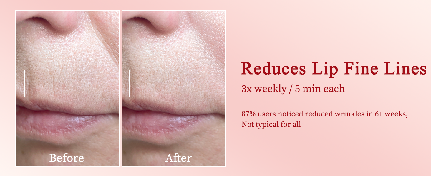 Radio Frequency Skin Tightening Device
