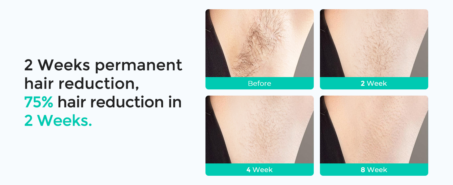 lubex ipl laser hair removal