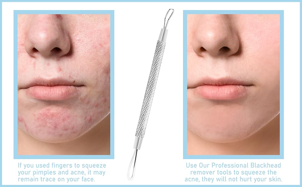 the skin care guide to acne