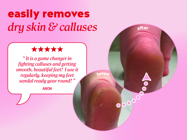 Customer review: It is a game changer in fighting calluses getting smooth beautiful feet.