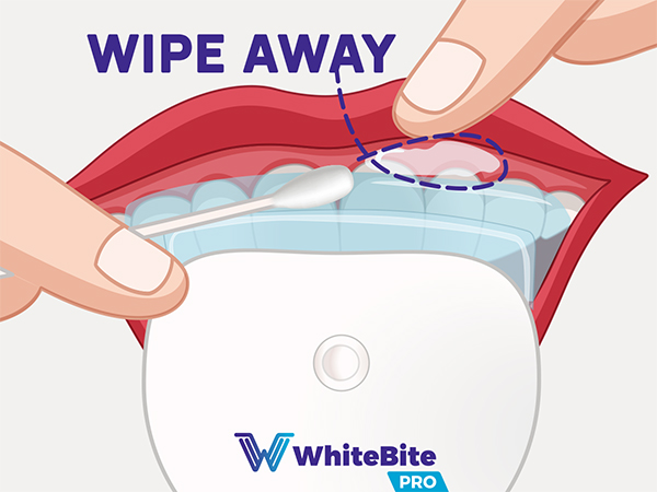 Teeth Whitening Kit