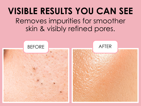 blemish skin tool