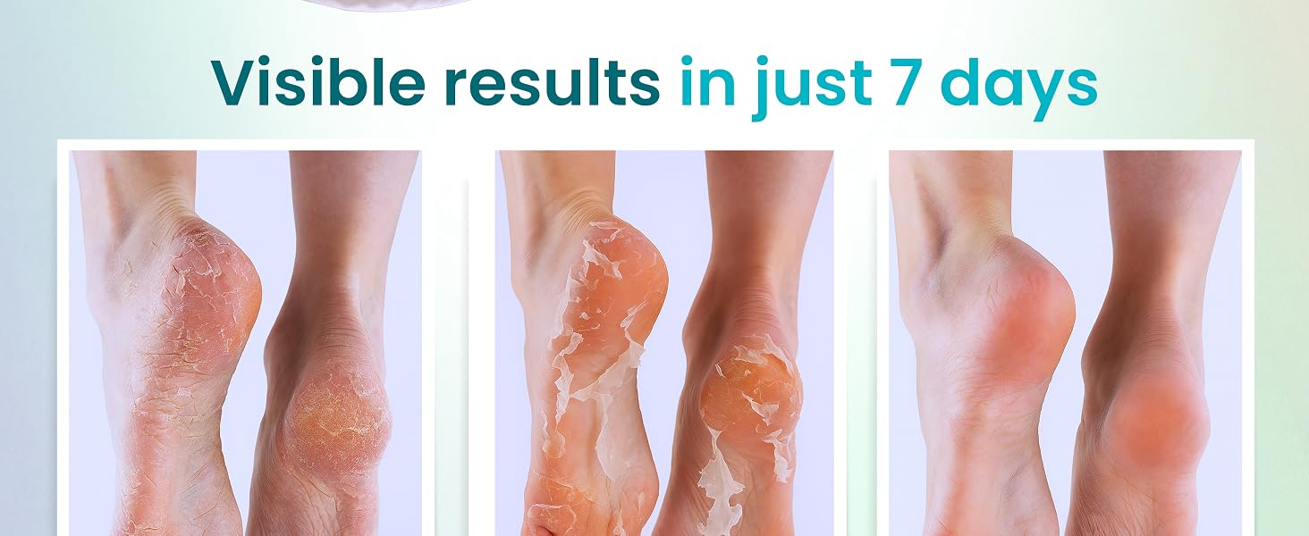 foot peel foot peel mask tca chemical peel foot mask peel foot peel mask for dry cracked feet extrem