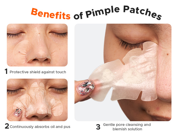 Benefits of Pimple Patches