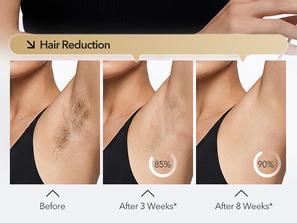 laser hair removal