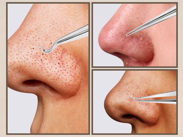 blackhead extractor tool