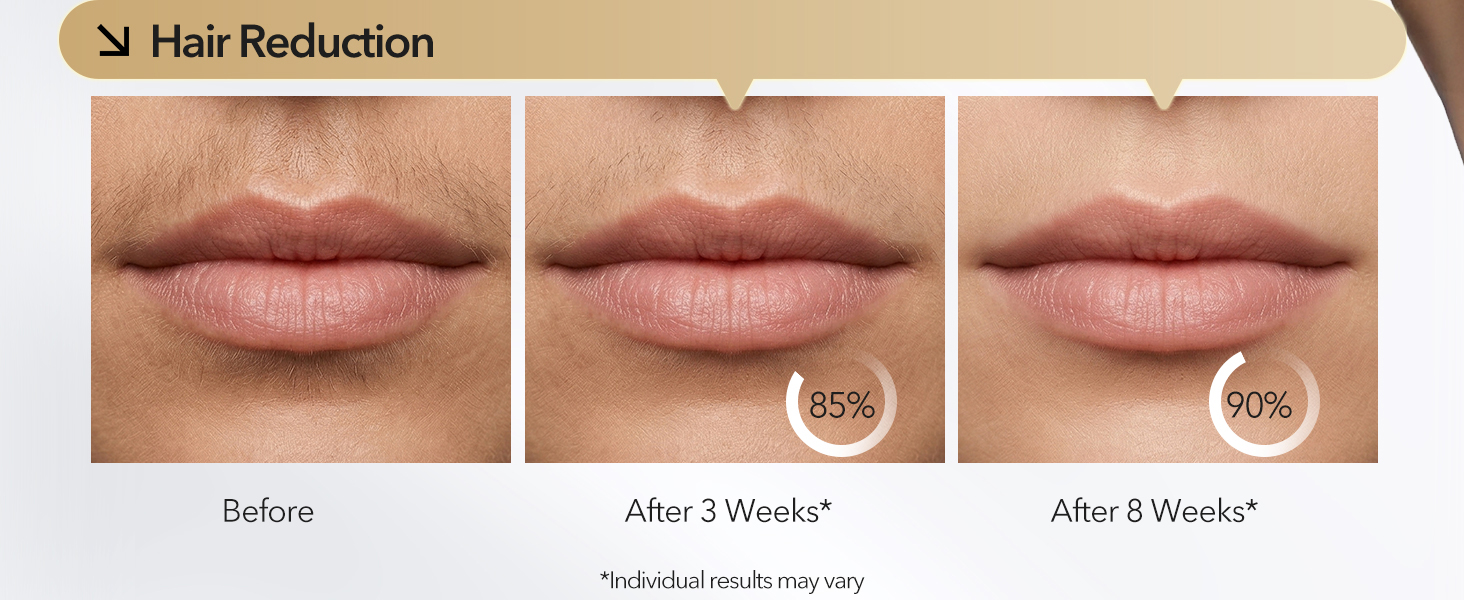 laser hair removal