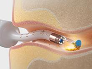Multiple cleaning methods